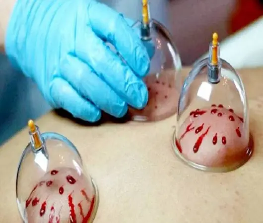 پاورپوینت فواید علمی و تاریخی حجامت در طب سنتی